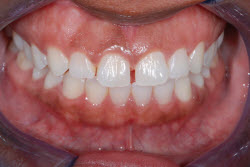 Invisalign and Orthodontics Welch Dental