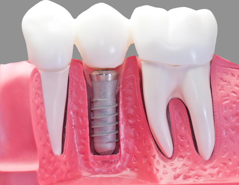 Dental Implants Katy Texas