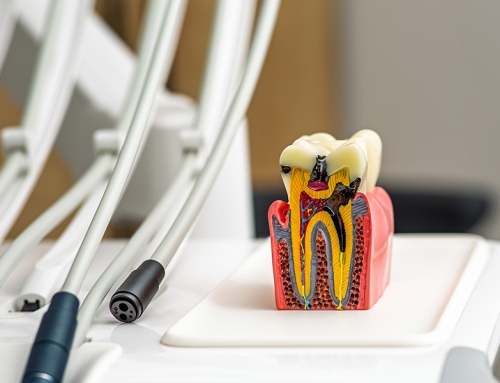 How Do I Know If I Need a Root Canal in Cypress, TX? Signs & Pain Relief Explained