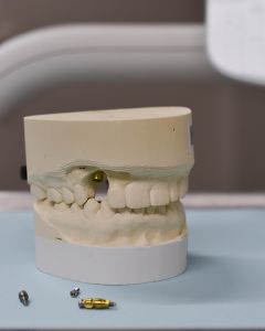 Dental work done in Katy Texas